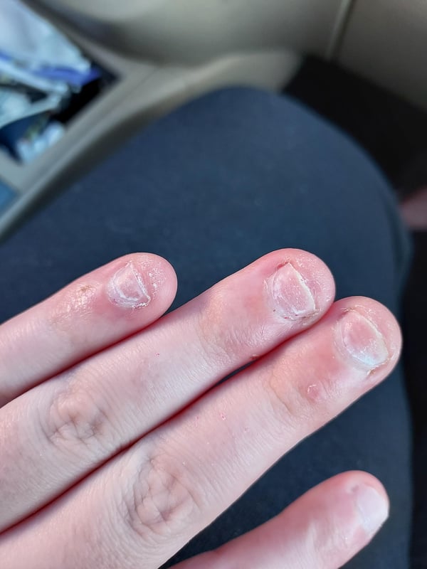 Picture by PumpkinLHC saying 'Took Off My Acrylics And Picked The Acrylic Part Off, Did I Damage My Nailbed?'