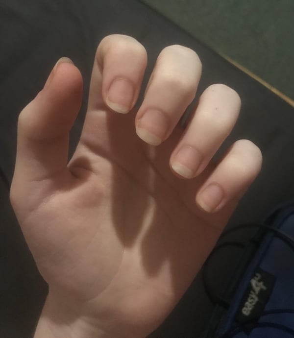 Picture by Daisy_the_blueberry saying 'Decided To Stop Biting My Nails 4 Weeks Ago, This Is The First Time In My Life I’ve Had Them Grow This Long : Second Pic Is The Before'