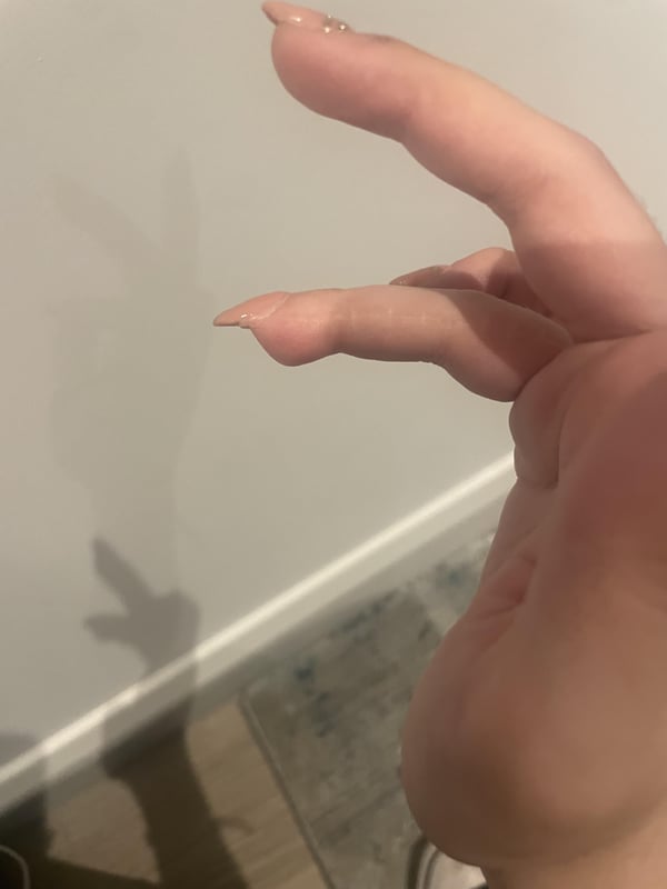 Picture by Financial-Tear-7809 showing 'I Managed To Get Acrylics Even Though I Had An Accident On A Finger/ Nail And I Am So Proud TW: Old Injury' number 2