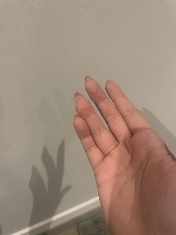 Picture by Financial-Tear-7809 showing 'I Managed To Get Acrylics Even Though I Had An Accident On A Finger/ Nail And I Am So Proud TW: Old Injury' number 3