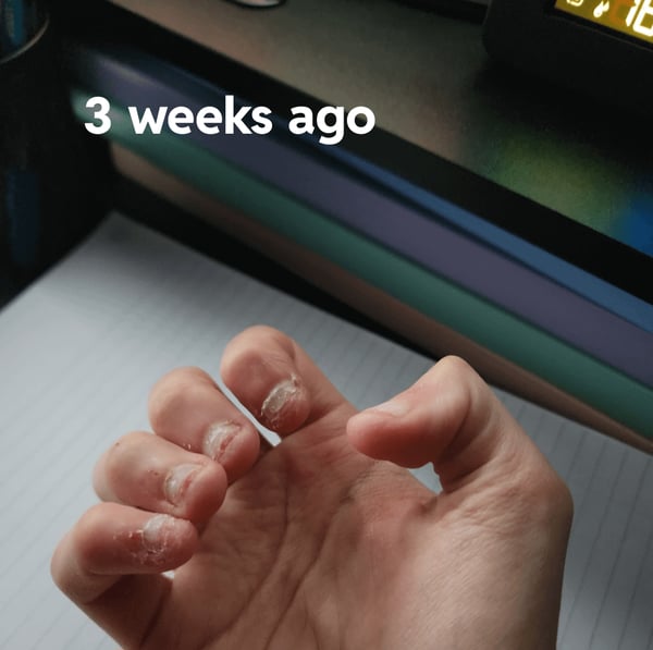 Picture by totheranch1 saying 'I've Bitten My Nails For A Decade. This Is The First Time I've Seen The White Parts.'