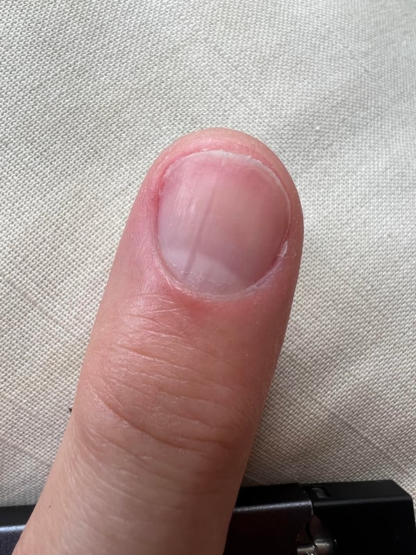 Picture by EricArtr saying 'Like Running Length Of My Nail, Cracks If Grown Out 😞 Any Advice?'