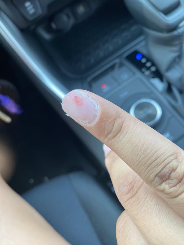 Picture by hockeycat2126 showing 'Nail Tech Drilled Into Nail Bed :' number 1