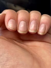 Why Are My Nails Peeling?