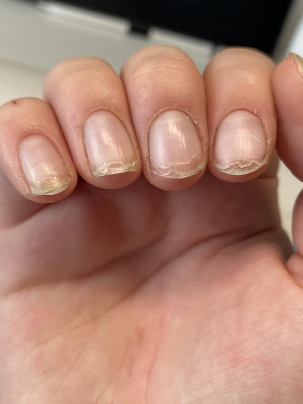 Picture by eemaymc showing 'Why Are My Nails Peeling?' number 1