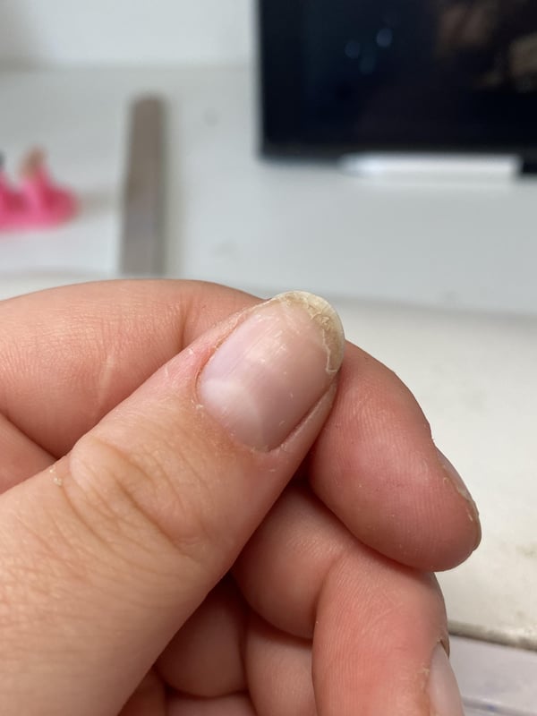 Picture by eemaymc showing 'Why Are My Nails Peeling?' number 2