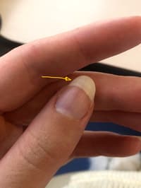 What Is This Horizontal Line On My Nail?