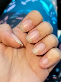 After 12 Years Of Biting My Nails, I've Finally Qui- Crap