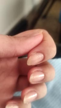 Why Does My Nail Grow Like That?