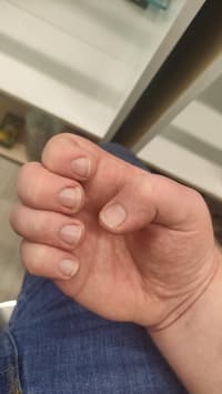 Stopped Biting Nails And Want To Fix Them