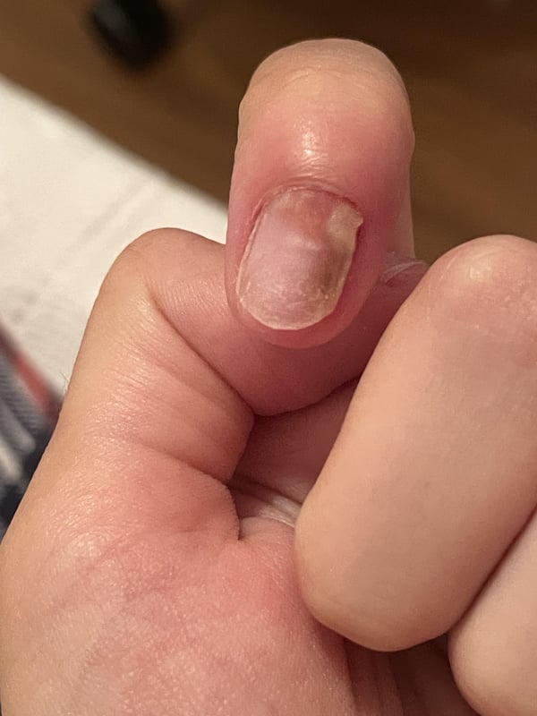 Picture by Secret_Cantaloupe935 showing 'My Nail Is Not Doing Well After An Acrylic.' number 3