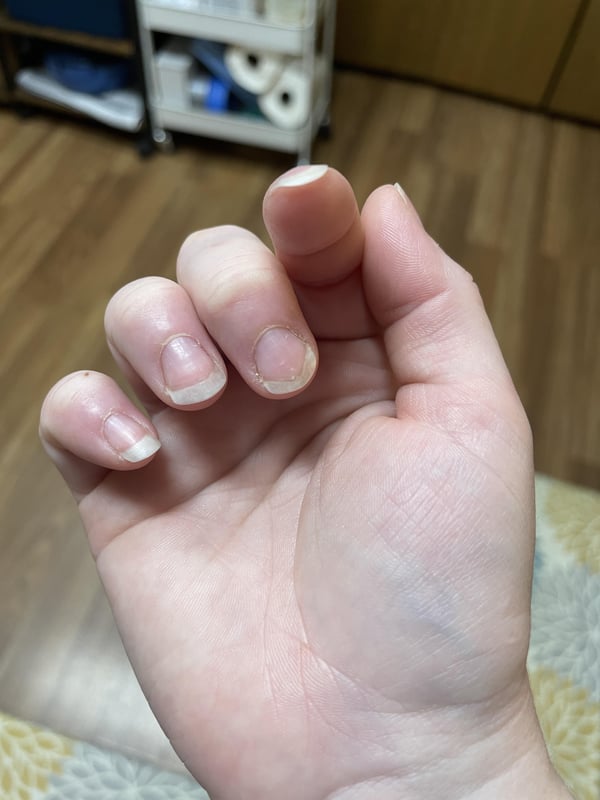 Picture by lisamd91 showing 'Why Does My Nail Do This? Typically It’s My Index And Middle Finger On Both Hands That Curl. Also How Do I Narrow Out My Middle Fingernails? They’re So Wide.' number 2