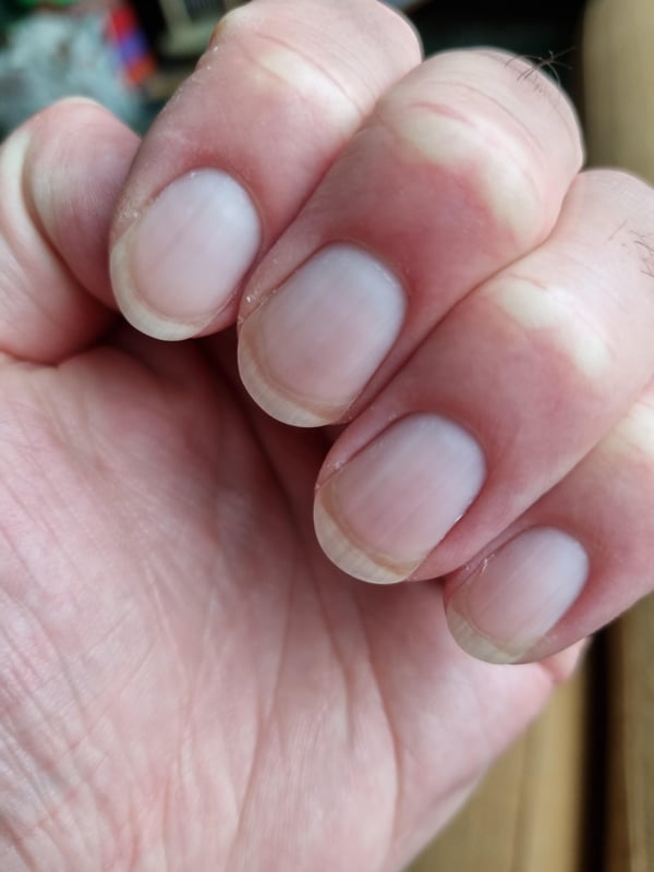 Picture by TheFearWithinYou saying 'What Is That Brown Section On My Nails And How Do I Get Rid Of It?'