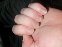 Why Do My Nails Look Like This? Do I Have A Deficiency?