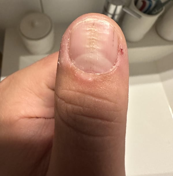 Picture by seltepe saying 'Nails Split/cracked In Middle Of Both Thumbs'