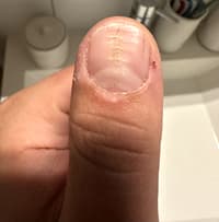 Nails Split/cracked In Middle Of Both Thumbs