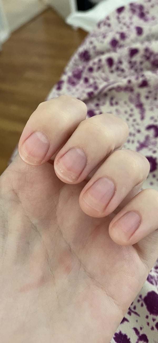 Picture by okcomputered saying 'Why Do My Nails Look Like This?? Is It Normal? They Aren't Dirty'