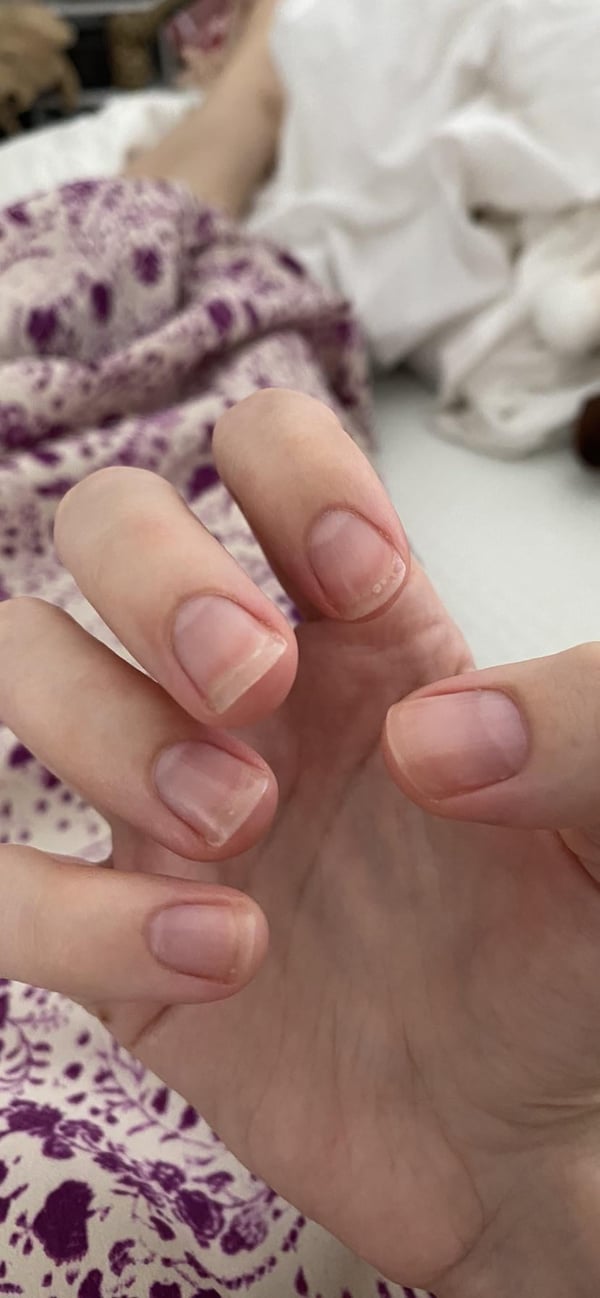 Picture by okcomputered showing 'Why Do My Nails Look Like This?? Is It Normal? They Aren't Dirty' number 2