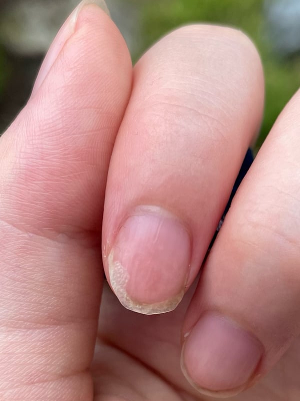 Picture by tootyfrootyhh saying 'Does Anyone Know What's Happening To My Nail? : And Anything I Can Do To Fix It?'