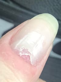 Can Someone Please Explain Why My Nail Stopped Growing At The Nail Bed, I’ve Had No Injury At All?