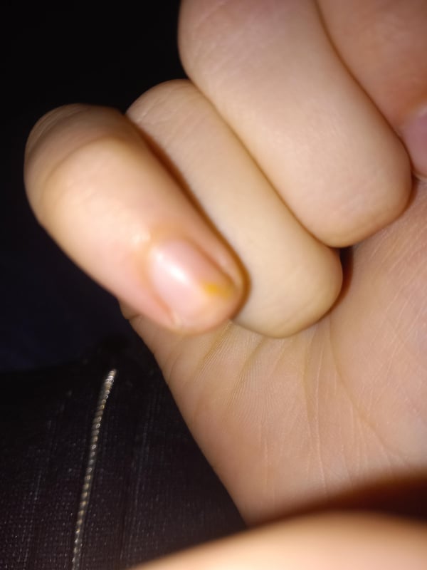 Picture by ShadxwRxses showing 'Yellow Stains On My Pinky Fingers.' number 2