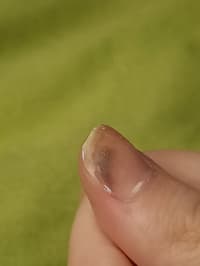 Weird Bruising After Gel Polish not Looking For Medical Advice